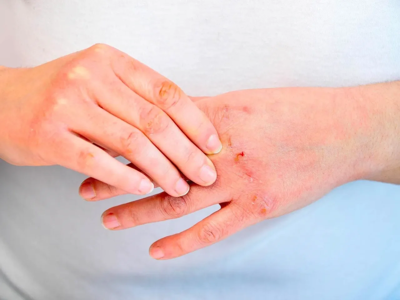 Dermatite: ecco quando guarisce da sola e quando è urgente intervenire